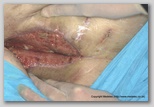Abdominal wound